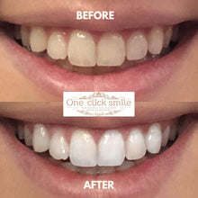 Load image into Gallery viewer, One Click Smile Teeth Whitening Kit before and after results.
